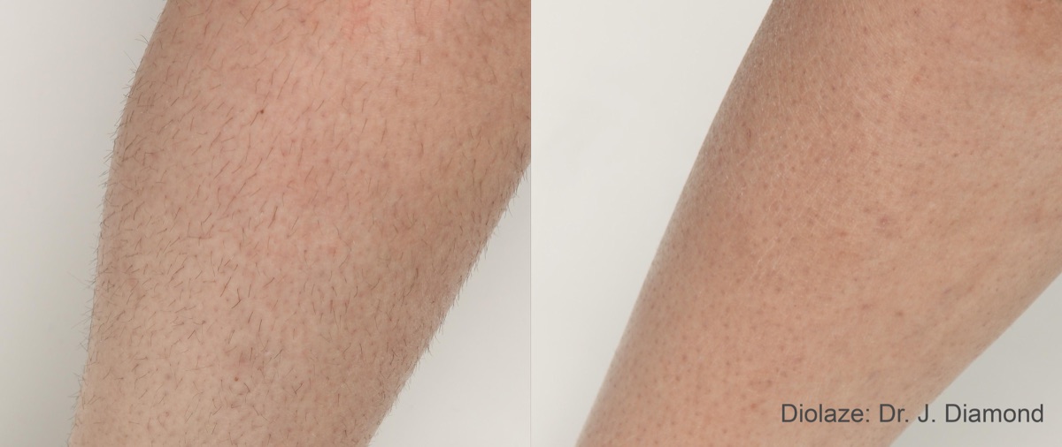 Diolaze laser hair removal before and after &mdash; smooth, hair-free skin after two diode laser sessions