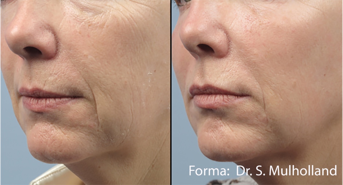 Forma RF skin tightening before and after &mdash; smoother jawline and reduced perioral wrinkles after a series of treatments