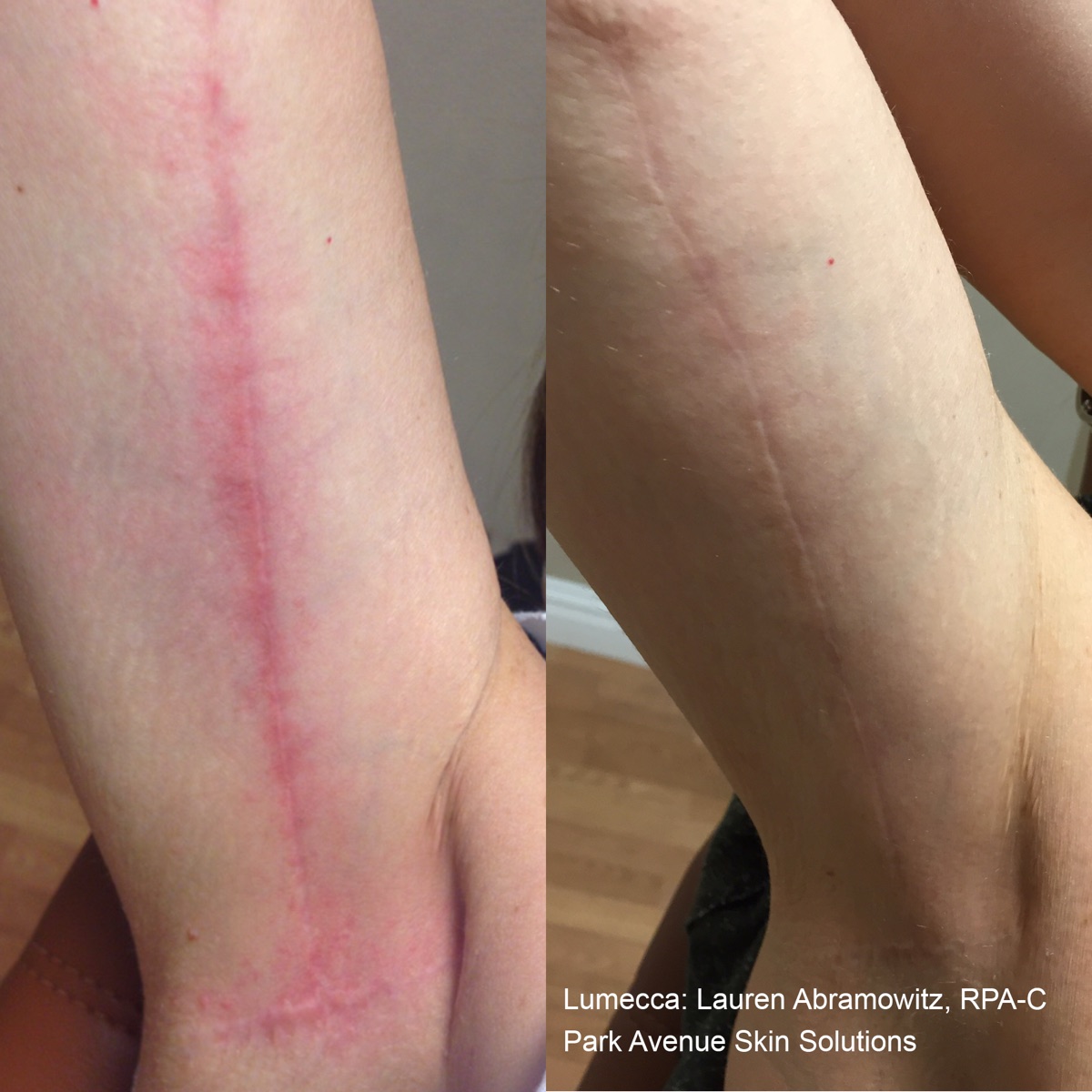 Lumecca IPL before and after &mdash; vascular irregularities cleared on the inner arm after a single intense pulsed light session