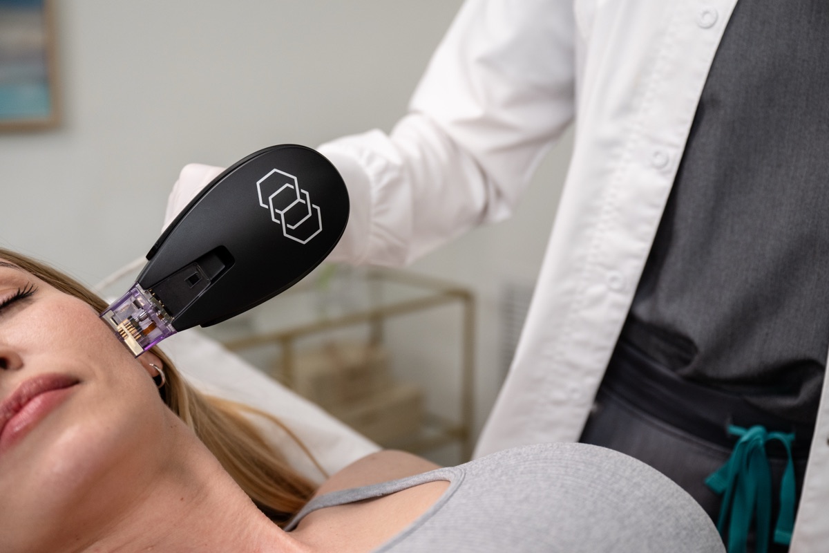 InMode Morpheus8 RF microneedling handpiece in treatment on a patient's cheek
